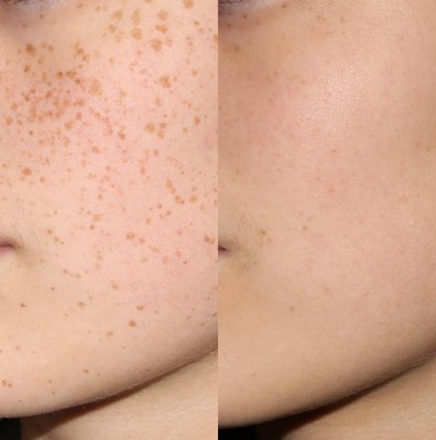 Photos of Patrick Bitter Jr, MD - Advanced Aesthetic Dermatology San Jose, CA