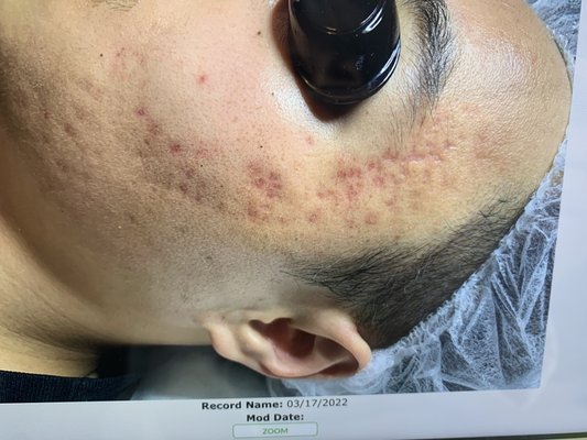 Photos of Clear Beauty Acne Clinic Denison, TX
